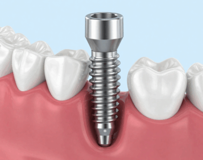 The Complete Guide to Dental Implants in Alpha, NJ 