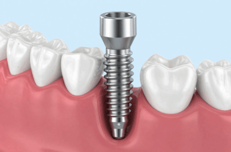 The Complete Guide to Dental Implants in Alpha, NJ 